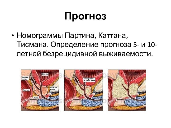 ПрогнозНомограммы Партина, Каттана, Тисмана. Определение прогноза 5- и 10- летней безрецидивной выживаемости.