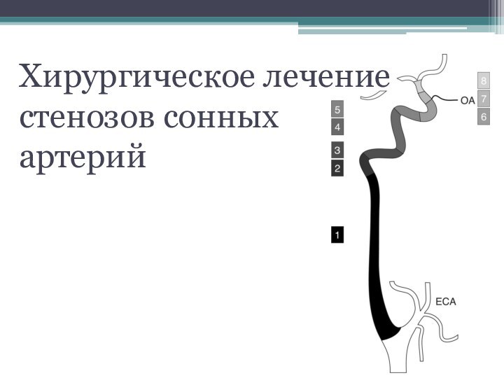 Хирургическое лечение стенозов сонных  артерий