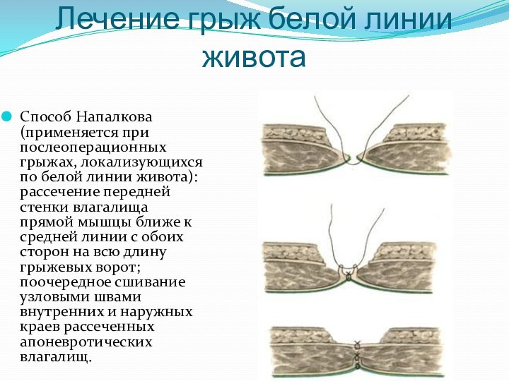 Лечение грыж белой линии животаСпособ Напалкова (применяется при послеоперационных грыжах, локализующихся по