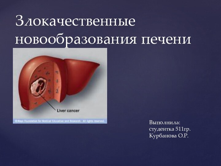 Злокачественные новообразования печениВыполнила: студентка 511гр. Курбанова О.Р.