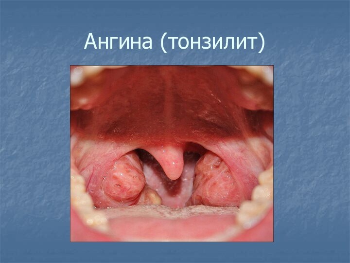 Ангина (тонзилит)