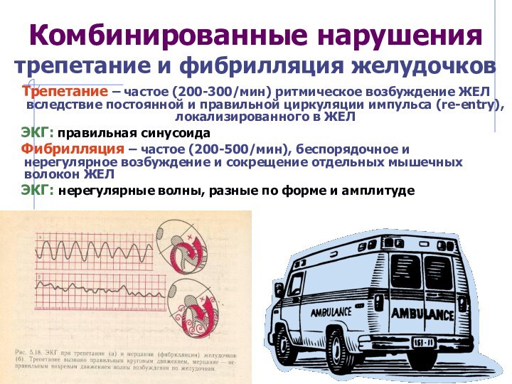 Комбинированные нарушения трепетание и фибрилляция желудочковТрепетание – частое (200-300/мин) ритмическое возбуждение ЖЕЛ