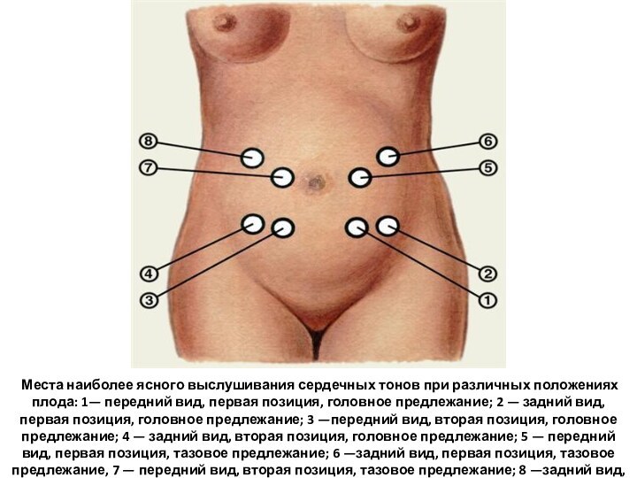 Места наиболее ясного выслушивания сердечных тонов при различных положениях плода: 1—