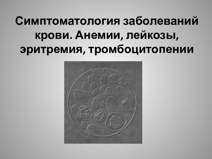 Симптоматология заболеваний крови. Анемии, лейкозы, эритремия, тромбоцитопении