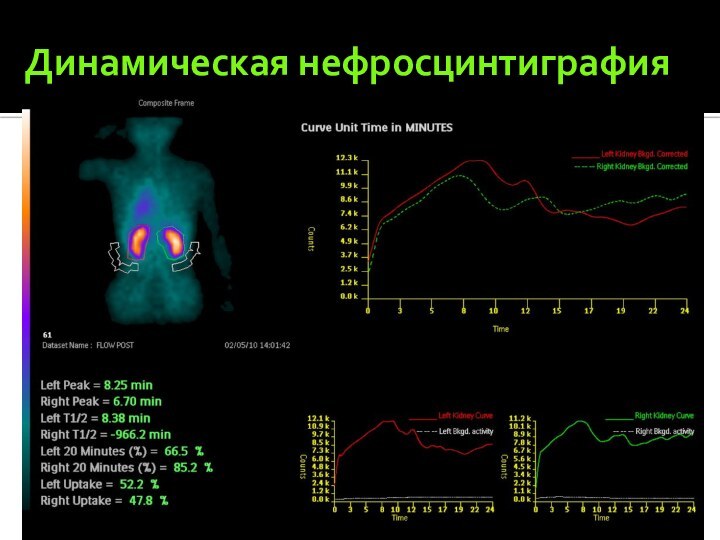 Динамическая нефросцинтиграфия