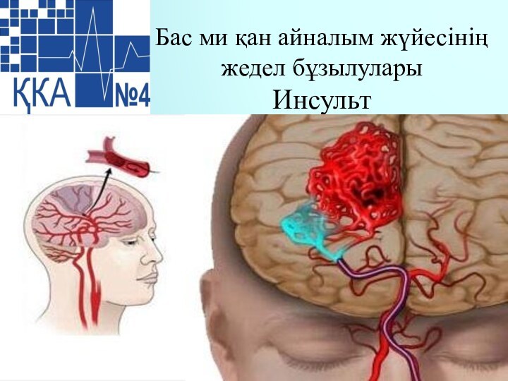 Бас ми қан айналым жүйесінің жедел бұзылулары  Инсульт