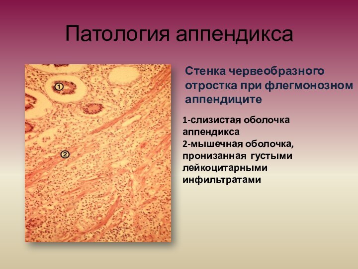 Патология аппендикса1-слизистая оболочка аппендикса2-мышечная оболочка, пронизанная густыми лейкоцитарными инфильтратамиСтенка червеобразного отростка при флегмонозном аппендиците