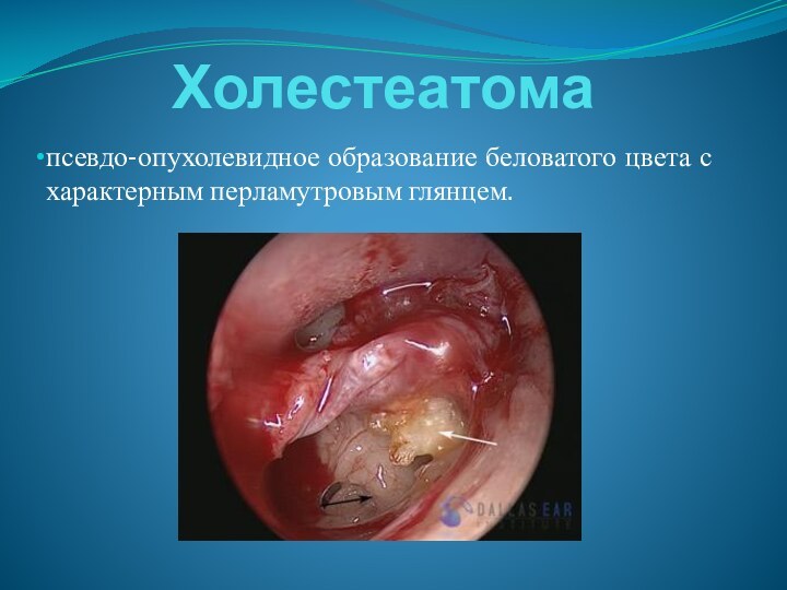 Холестеатома псевдо-опухолевидное образование беловатого цвета с характерным перламутровым глянцем.