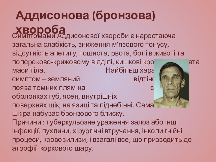 Симптомами Аддисонової хвороби є наростаюча загальна слабкість, зниження м’язового тонусу, відсутність апетиту,