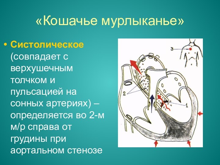 «Кошачье мурлыканье»Систолическое (совпадает с верхушечным толчком и пульсацией на сонных артериях) –