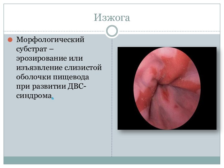 ИзжогаМорфологический субстрат – эрозирование или изъязвление слизистой оболочки пищевода при развитии ДВС-синдрома.