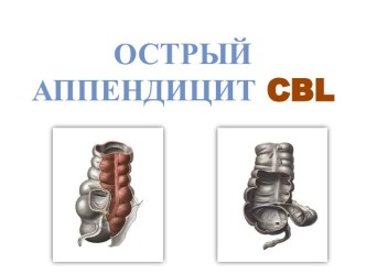 Острый аппендицит cbl