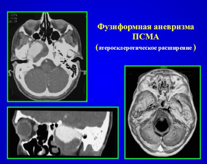 Фузиформная аневризма ПСМА (атеросклеротическое расширение )