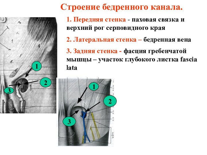 Строение бедренного канала.1. Передняя стенка - паховая связка и верхний рог серповидного