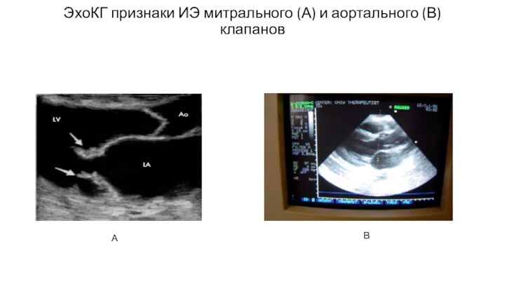 ЭхоКГ признаки ИЭ митрального (А) и аортального (В) клапановАВ