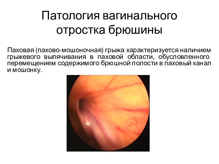Патология вагинального отростка брюшиныПаховая (пахово-мошоночная) грыжа характеризуется наличием грыжевого выпячивания в паховой
