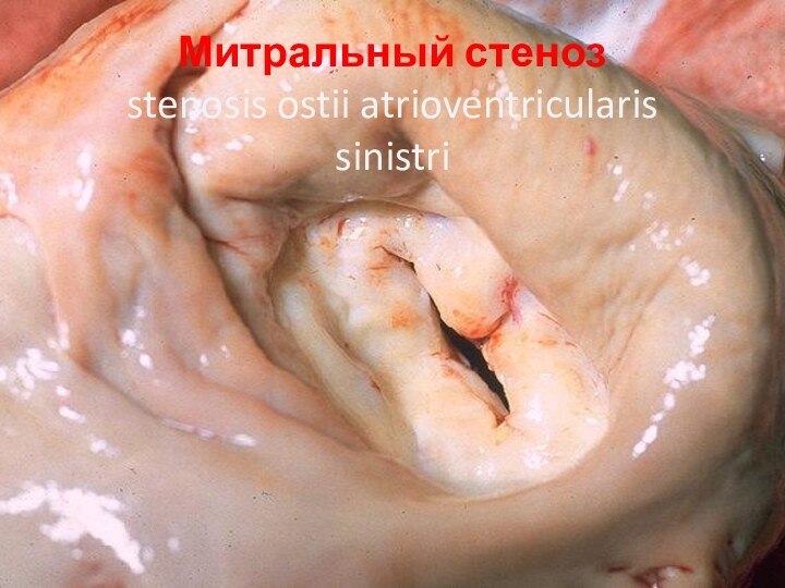 Митральный стеноз  stenosis ostii atrioventricularis sinistri