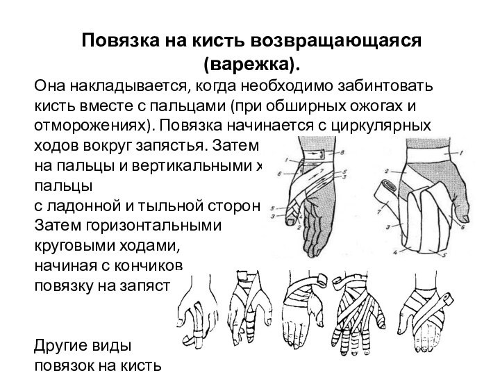 Повязка на кисть возвращающаяся (варежка). Она накладывается, когда необходимо забинтовать кисть вместе