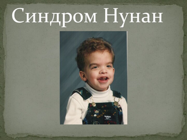 Синдром Нунан