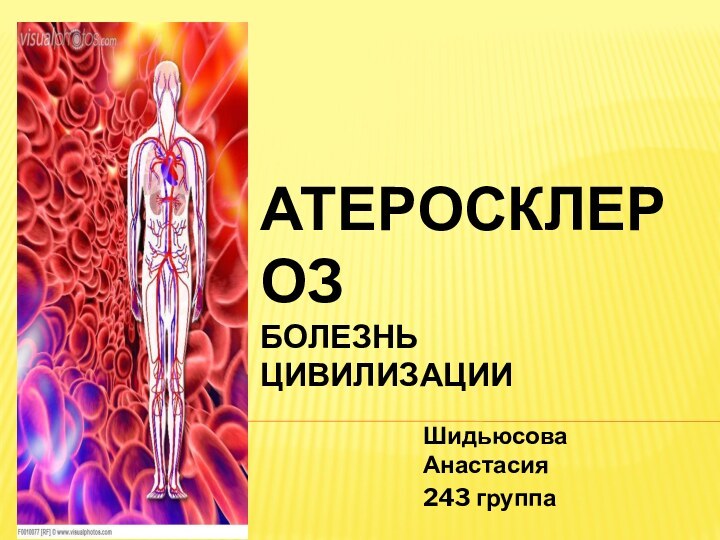 АТЕРОСКЛЕРОЗ БОЛЕЗНЬ ЦИВИЛИЗАЦИИШидьюсова Анастасия243 группа