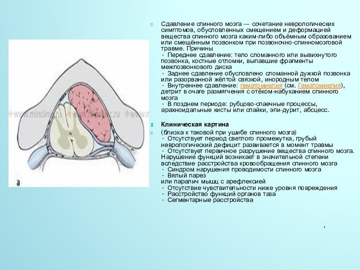 •Сдавление спинного мозга — сочетание неврологических симптомов, обусловленных смещением и деформацией
