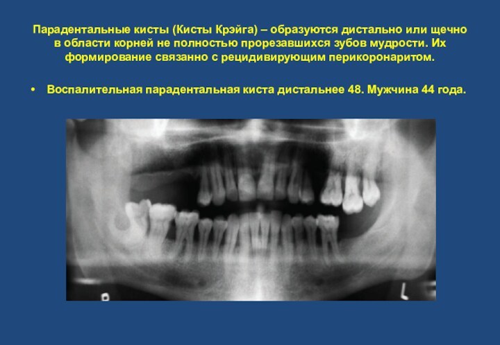 Парадентальные кисты (Кисты Крэйга) – образуются дистально или щечно в области корней