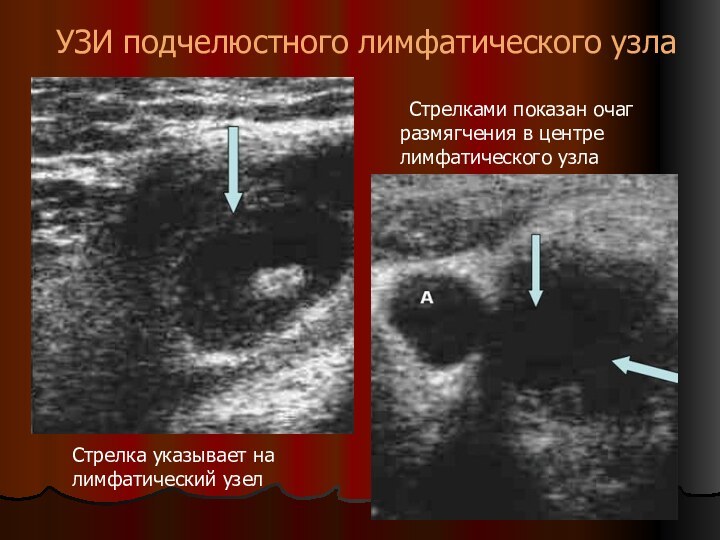 УЗИ подчелюстного лимфатического узла	Стрелками показан очаг размягчения в центре лимфатического узлаСтрелка указывает на лимфатический узел