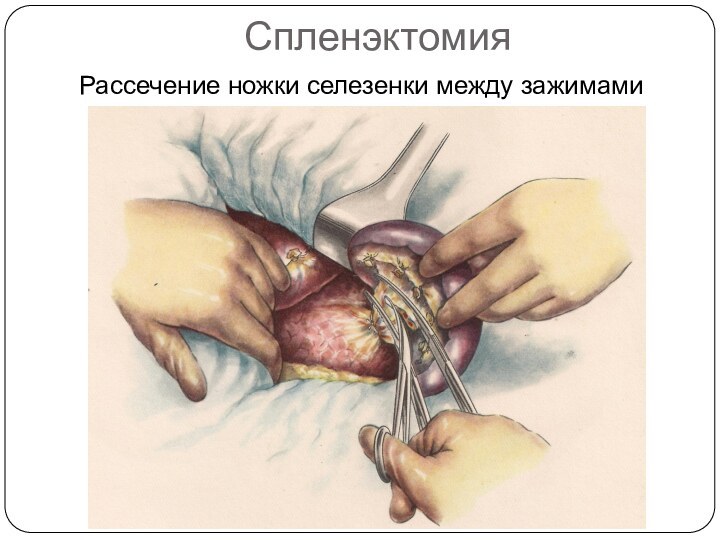 СпленэктомияРассечение ножки селезенки между зажимами