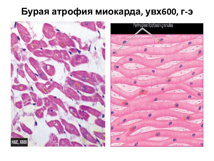 Бурая атрофия миокарда, увх600, г-э