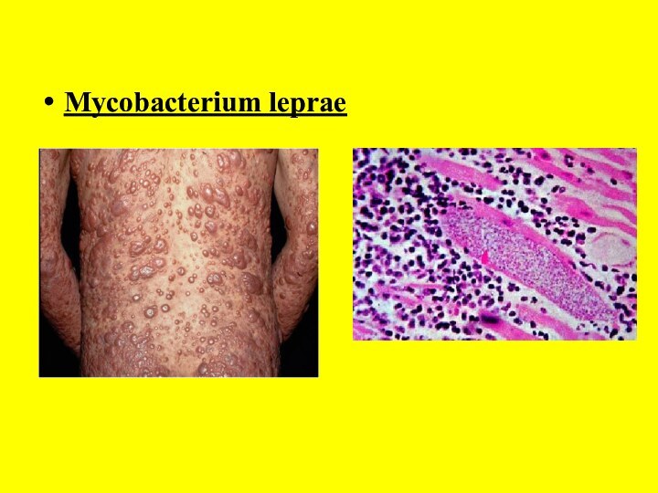 Mycobacterium leprae