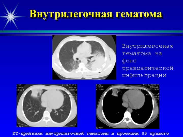 Внутрилегочная гематома  КТ-признаки внутрилегочной гематомы в проекции S5 правого легкогоВнутрилегочнаягематома на фоне травматической инфильтрации