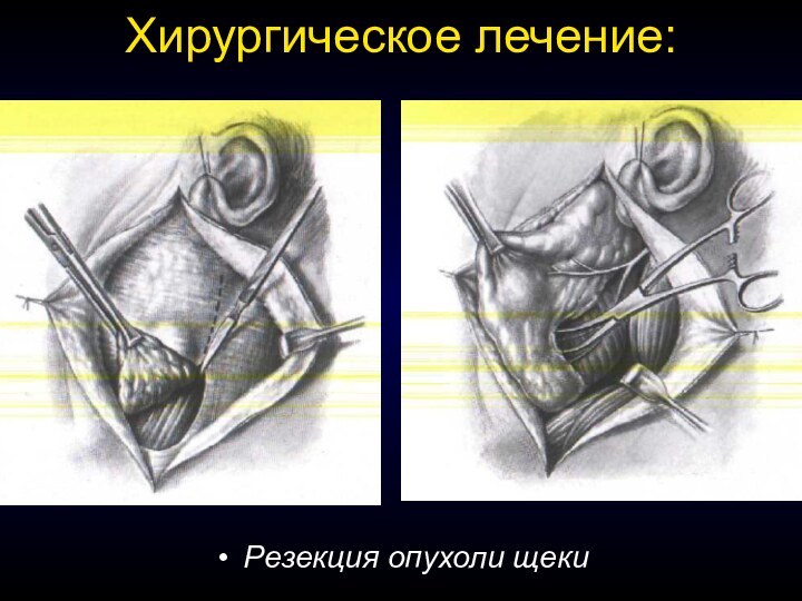 Хирургическое лечение:Резекция опухоли щеки