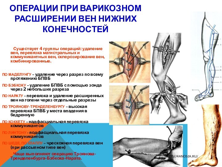 ОПЕРАЦИИ ПРИ ВАРИКОЗНОМ РАСШИРЕНИИ ВЕН НИЖНИХ КОНЕЧНОСТЕЙ	Существует 4 группы операций: удаление вен,