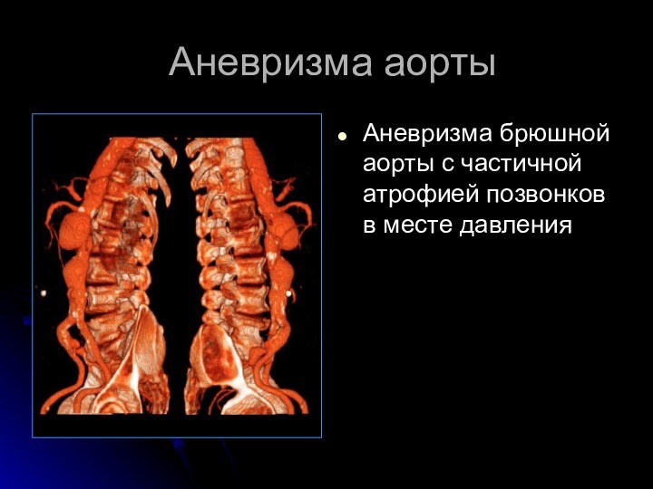 Аневризма аортыАневризма брюшной аорты с частичной атрофией позвонков в месте давления