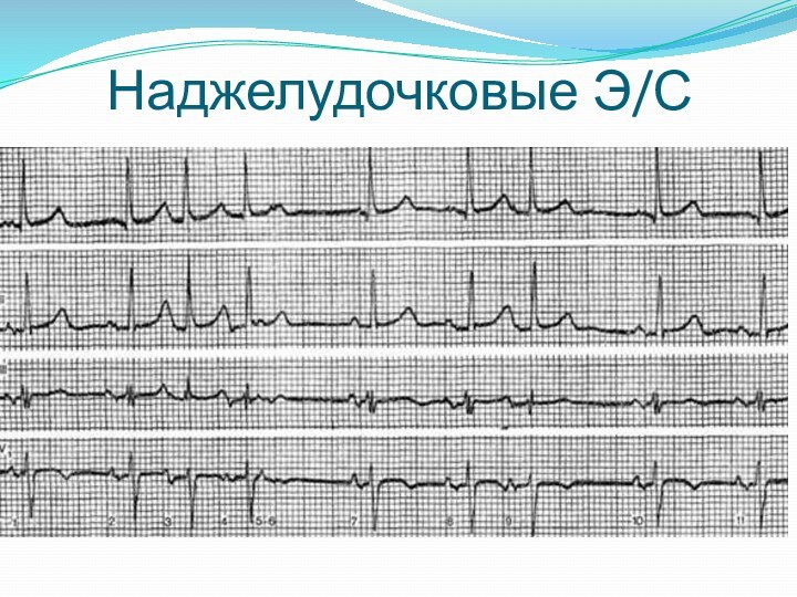 Наджелудочковые Э/С