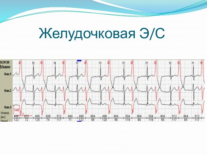 Желудочковая Э/С