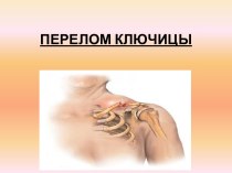 ПЕРЕЛОМ КЛЮЧИЦЫ