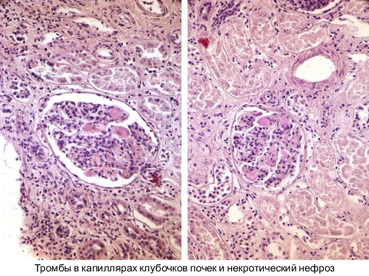 Тромбы в капиллярах клубочков почек и некротический нефроз