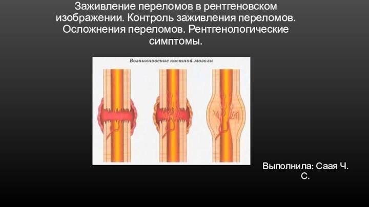 Заживление переломов в рентгеновском изображении. Контроль заживления переломов. Осложнения переломов. Рентгенологические симптомы.Выполнила: Саая Ч.С.