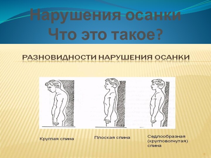 Нарушения осанки  Что это такое? 