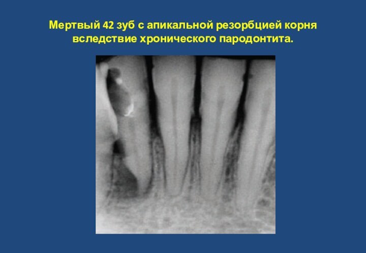 Мертвый 42 зуб с апикальной резорбцией корня вследствие хронического пародонтита.