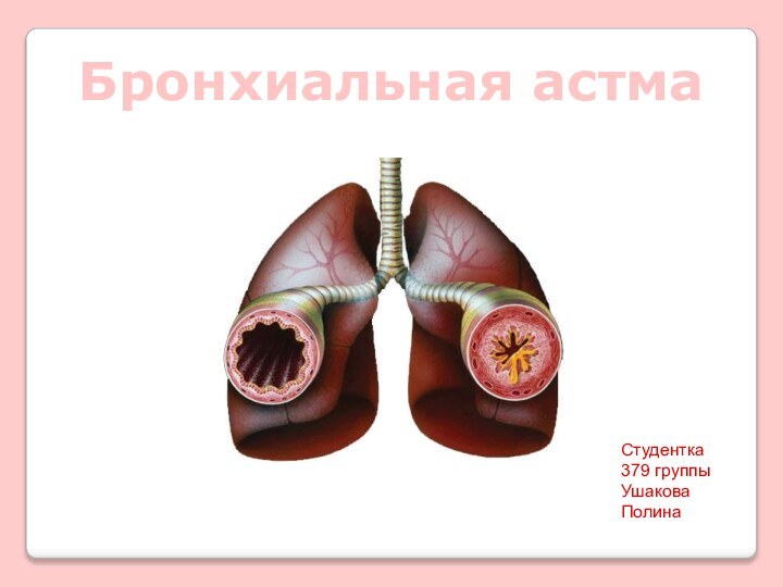 Бронхиальная астмаСтудентка 379 группы Ушакова Полина