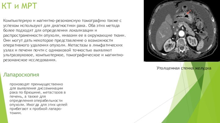 КТ и МРТКомпьютерную и магнитно-резонансную томографию также с успехом используют для диагностики