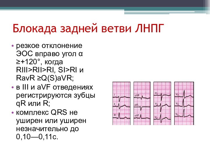 Блокада задней ветви ЛНПГрезкое отклонение ЭОС вправо угол α ≥+120°, когда RIII>RII>RI,