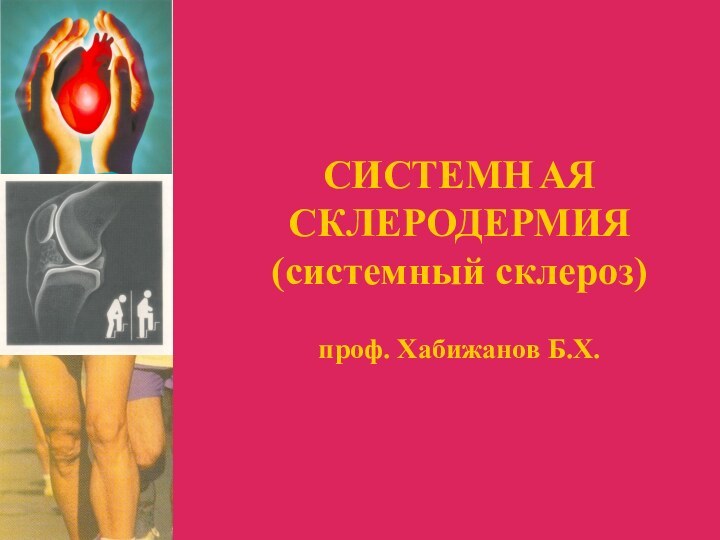 СИСТЕМН	АЯ СКЛЕРОДЕРМИЯ (системный склероз)  проф. Хабижанов Б.Х.