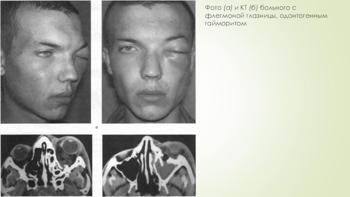 Фото (а) и КТ (б) больного с флегмоной глазницы, одонтогенным гайморитом