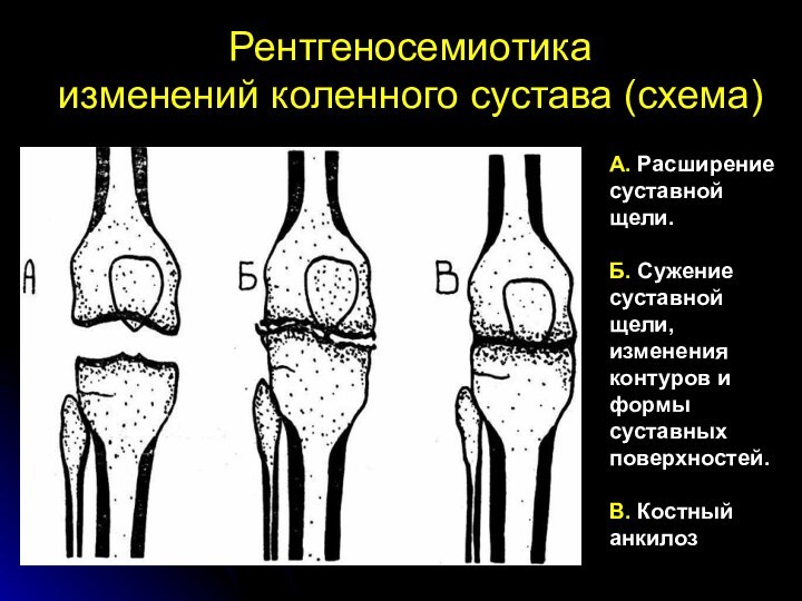 Рентгеносемиотика изменений коленного сустава (схема)А. Расширение суставной щели.Б. Сужение суставной щели, изменения