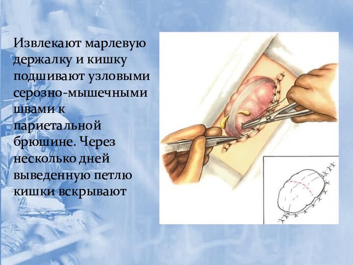 Извлекают марлевую держалку и кишку подшивают узловыми серозно-мышечными швами к париетальной брюшине.