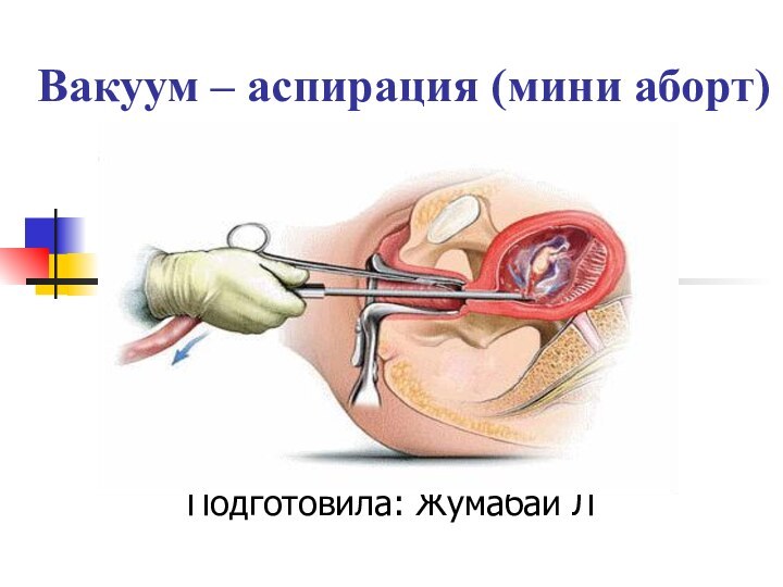 Вакуум – аспирация (мини аборт)Подготовила: Жумабай Л