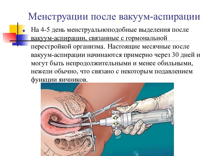 Менструации после вакуум-аспирации На 4-5 день менструальноподобные выделения после вакуум-аспирации, связанные с